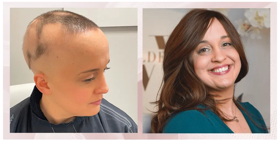 Why Local Hair Replacement Specialists Deliver Better Results