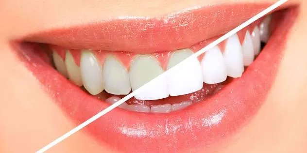 How Do You Use Dental Whitening Services?