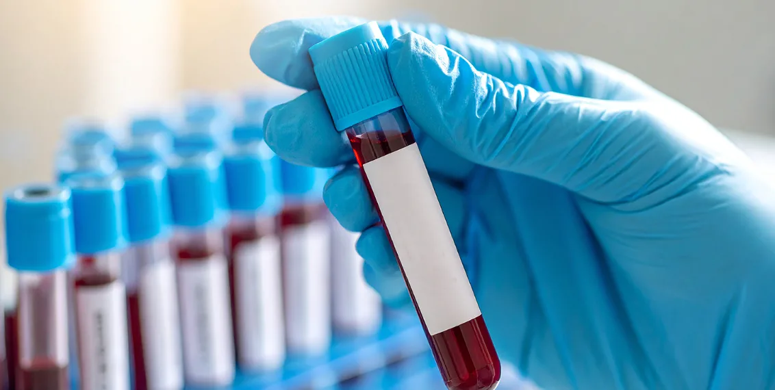 CRP Test Price: Cost, Purpose, Procedure, Preparation & Benefits