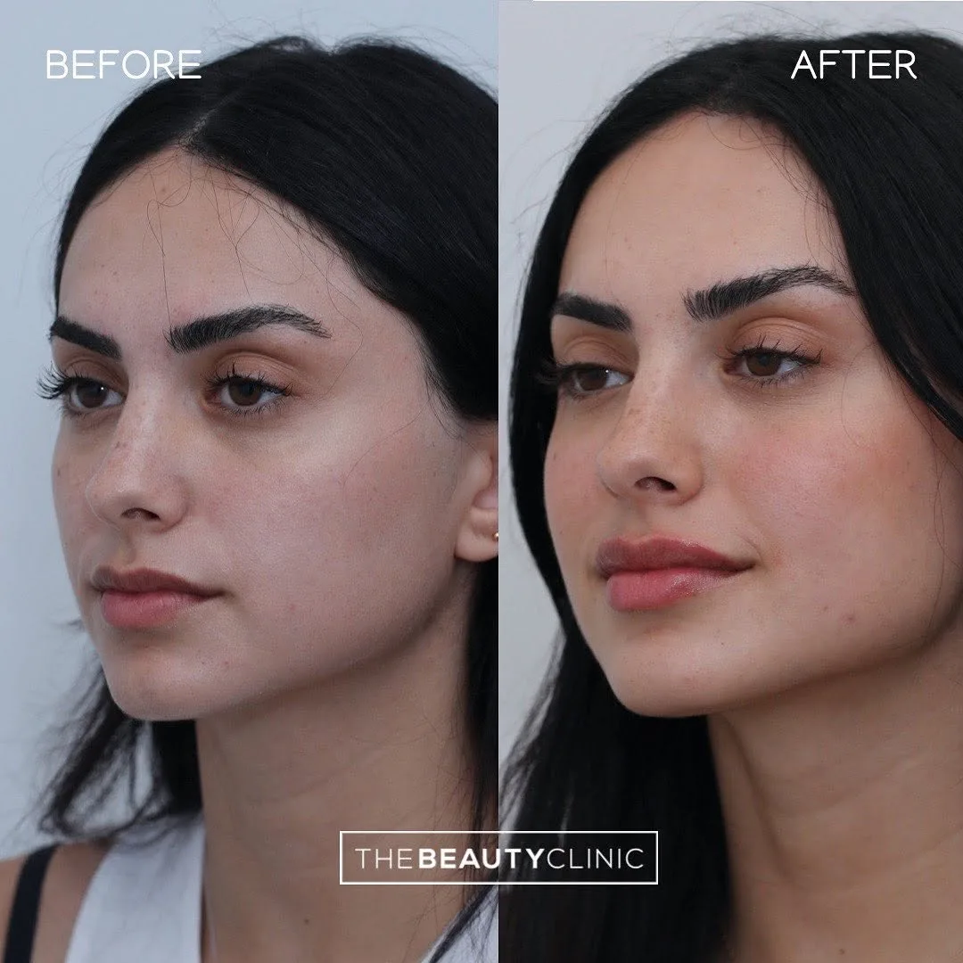 How Does PRF Work Beneath the Skin to Reduce Signs of Aging?