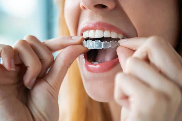 A Comfortable and Convenient Approach to Teeth Straightening