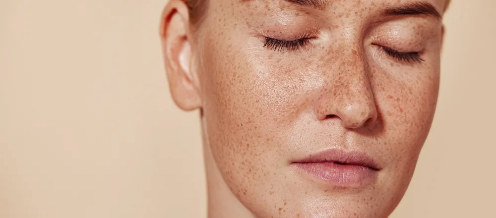 Pigmentation Treatment in Dubai: Best Solutions for Sun Damage and Dark Spots