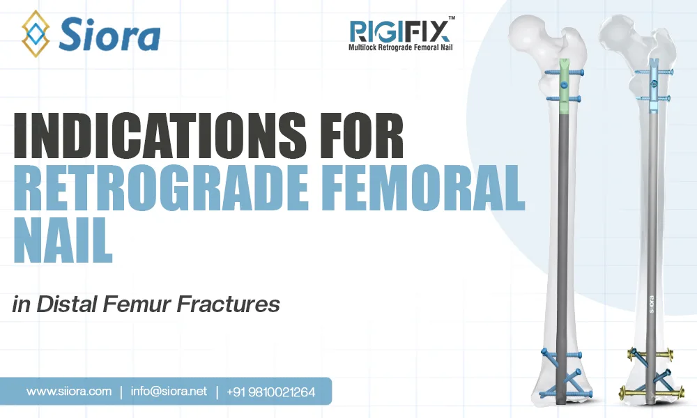 Indications for Retrograde Femoral Nail in Distal Femur Fractures