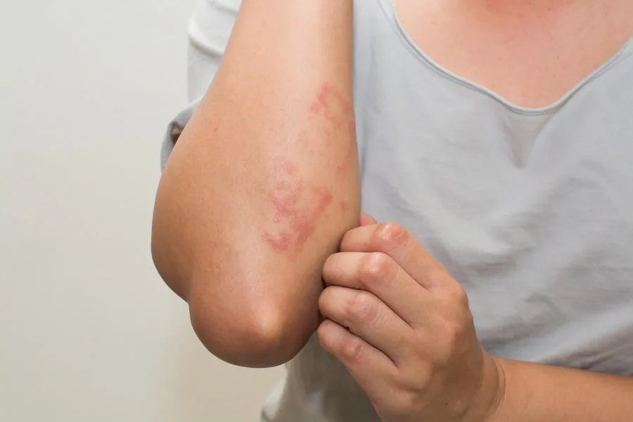 How Eczema Treatment Helps Restore Healthy and Comfortable Skin