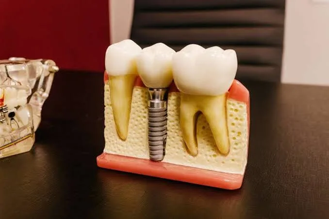 Dental Implants: Causes, Benefits & What Patients Should Know Before Treatment