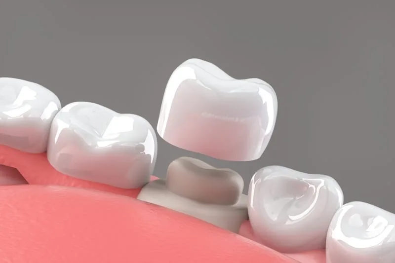 Top Ways to Save on Dental Crown Treatment