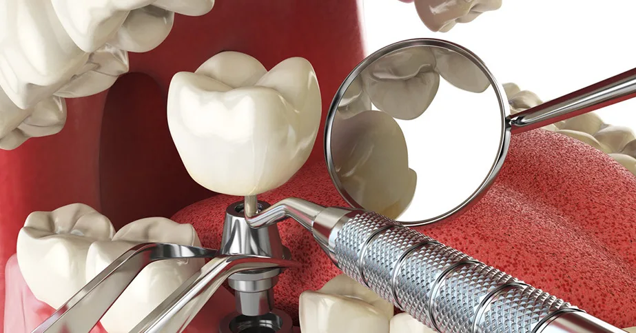 Everything You Need to Know About Dental Oral Surgery Before Treatment