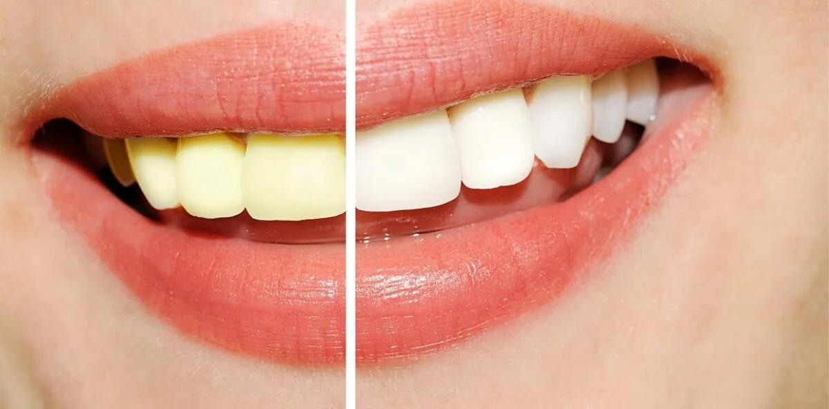 How to Choose the Right Cosmetic Dental Treatment for Your Smile Goals in East Brunswick