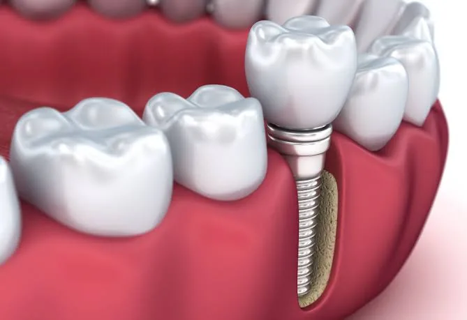 Brighten Your Smile with Complete Dental: Expert Implant Dentistry and Cosmetic Dental Procedures in Houston, TX
