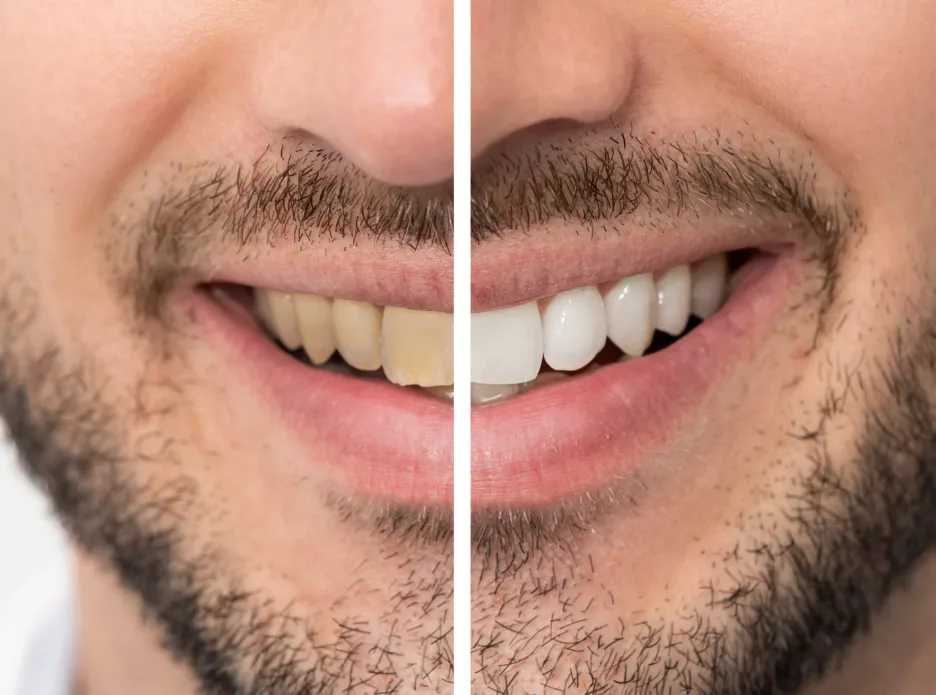 How Long Do Teeth Whitening Results Last?