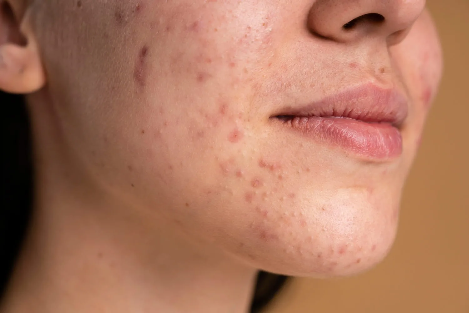 Which Acne Treatment Is Right for Your Skin Type?