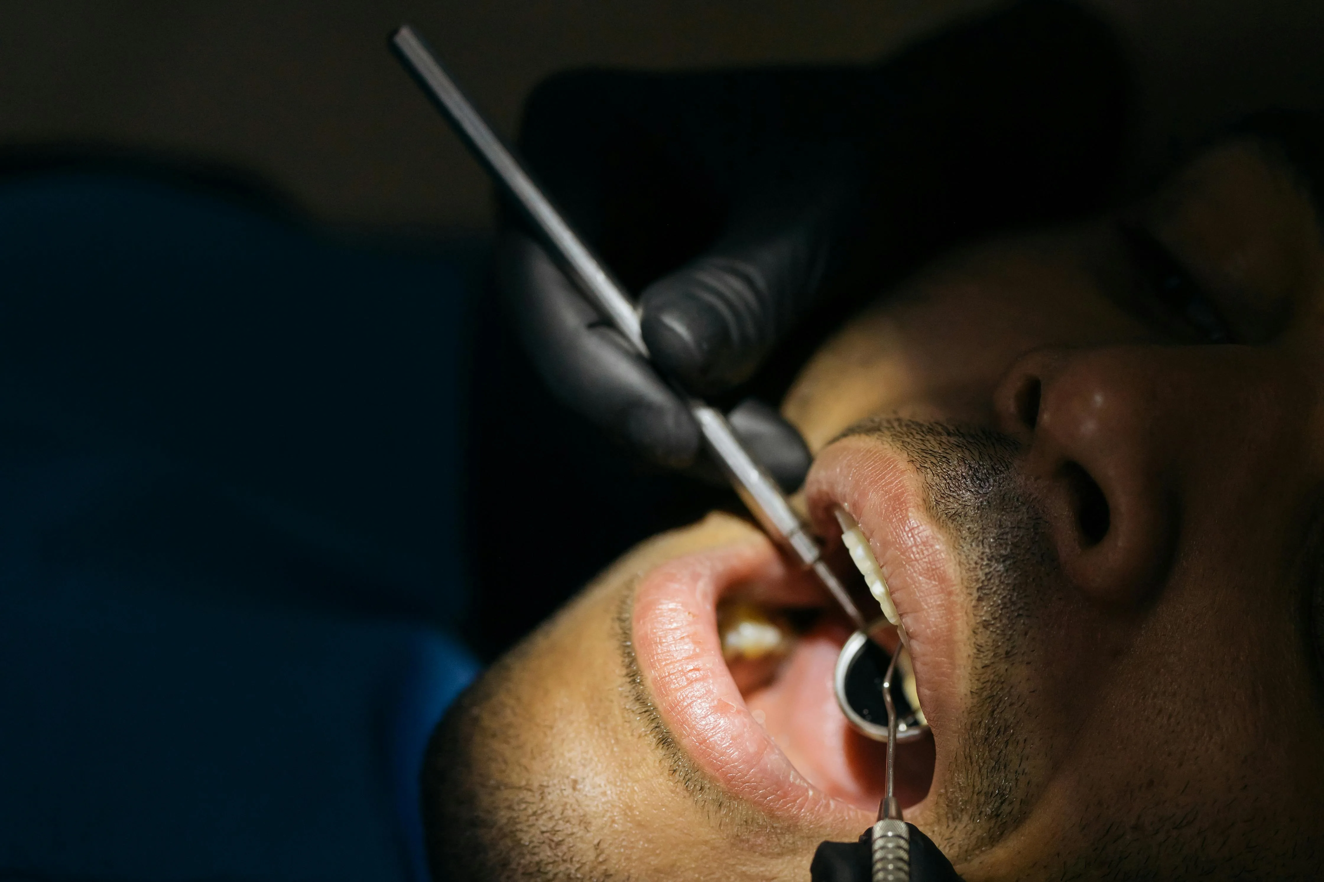 What Causes Cavities and How to Prevent Them