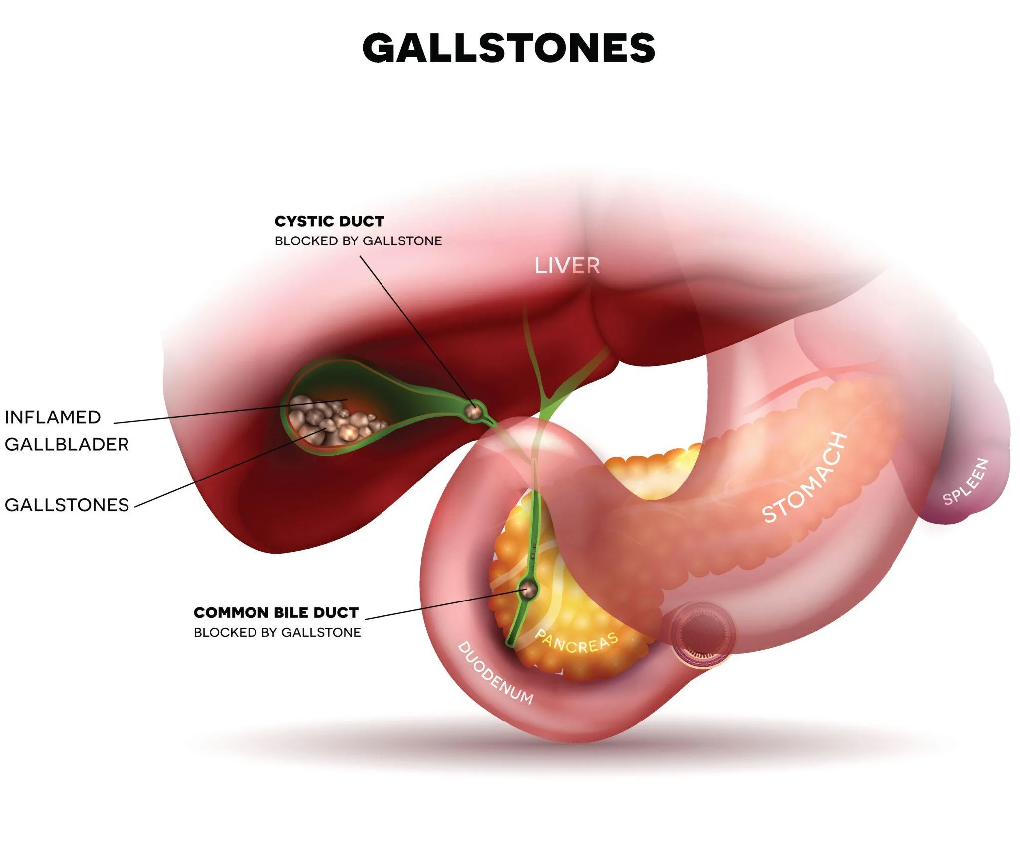 Understanding Hernia, Piles, and Gallbladder Surgery: A Complete Guide