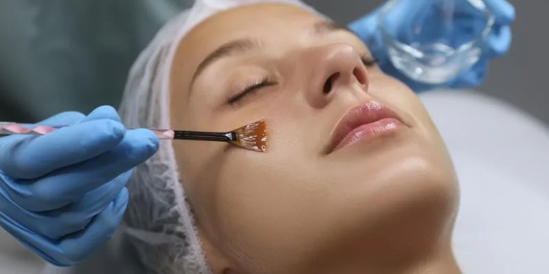 How a Chemical Face Peel Treatment Can Transform Your Skin
