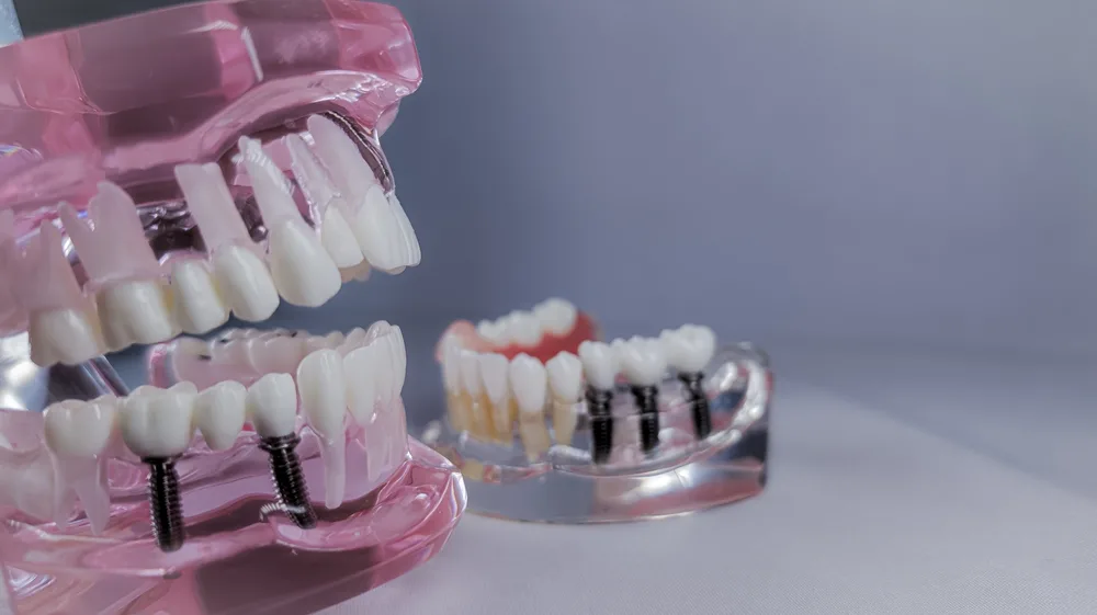 Why Dental Implants in Miami Are Considered the Gold Standard for Tooth Replacement?