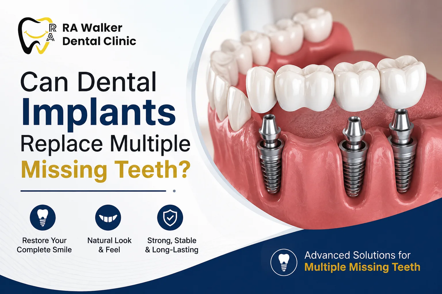 Can Dental Implants Replace Multiple Missing Teeth?