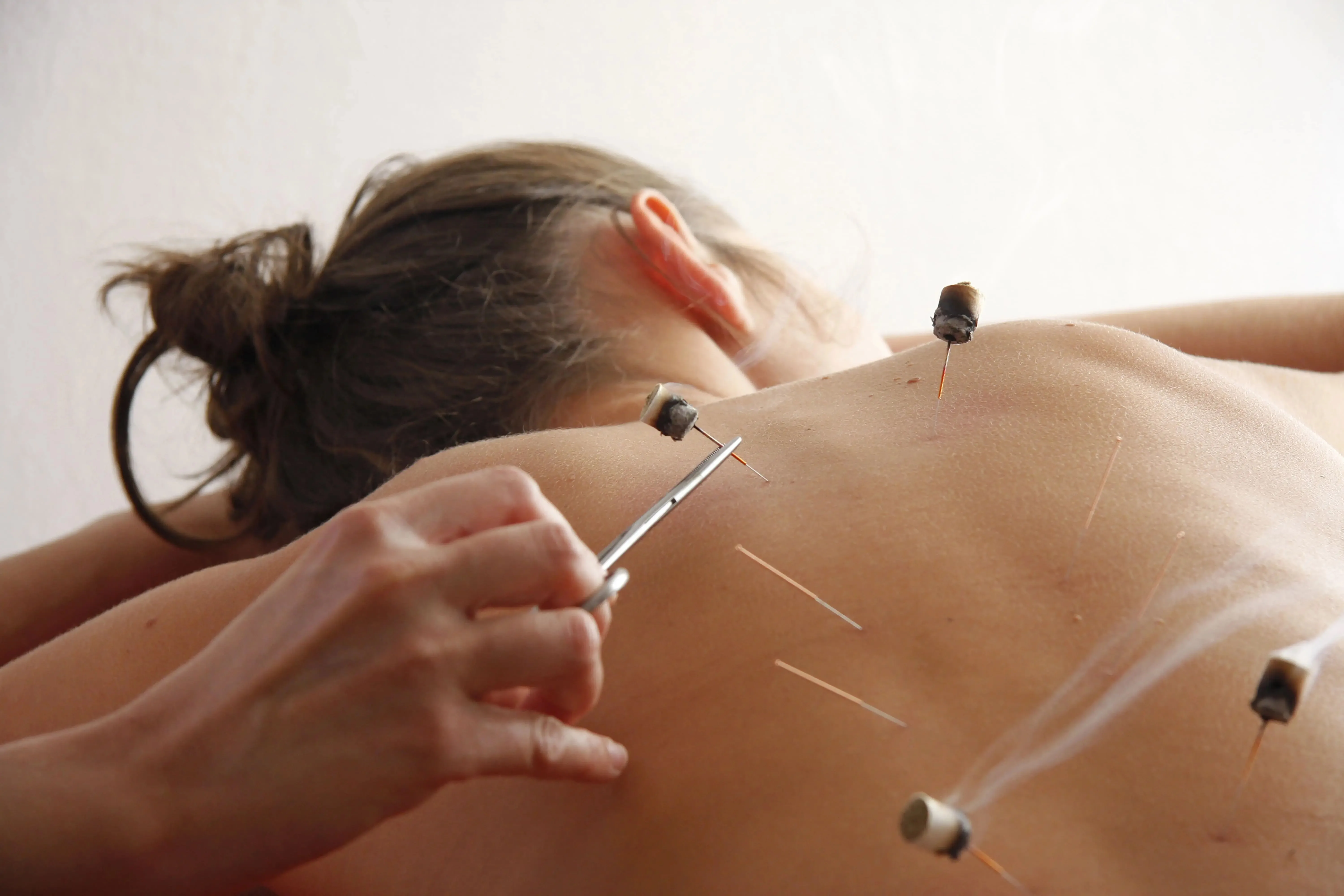 Acupuncture for Weight Control: Natural Way to Manage Weight