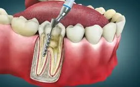 RCT Cost Explained: What Determines the Price of Treatment?