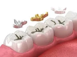 How Much Does Dental Filling Treatment Cost and What Affects the Price?