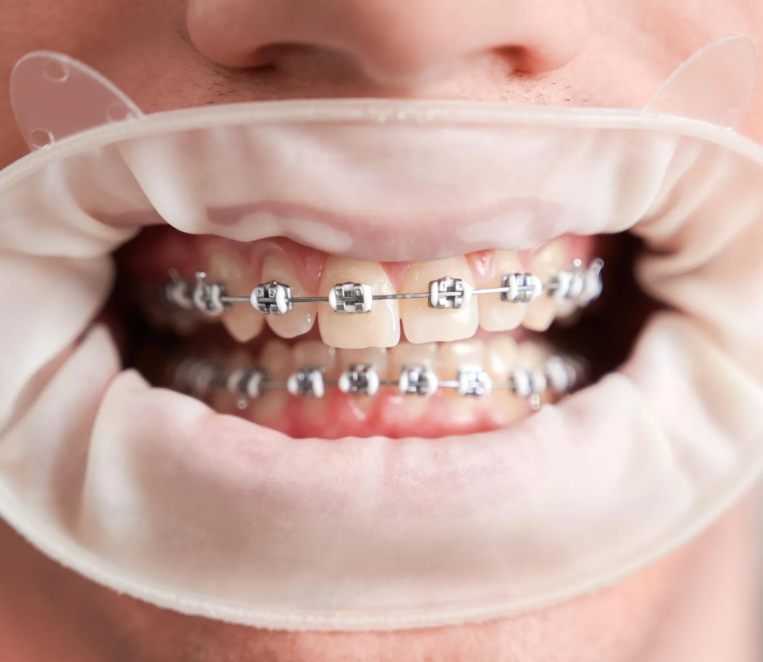 Why Should You Choose a Westlake Orthodontist for a Healthier and More Confident Smile?