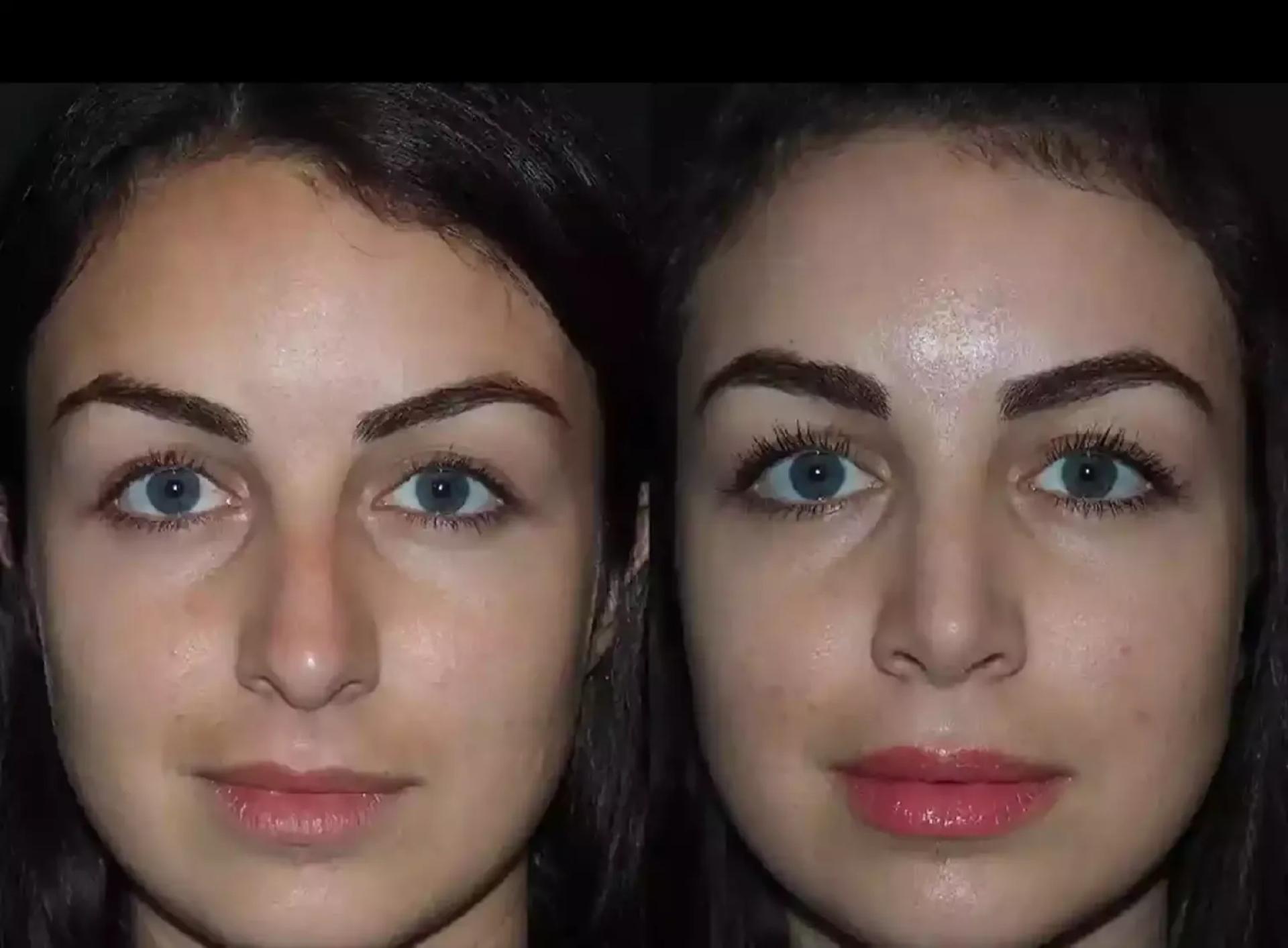 Ethnic Rhinoplasty in Dubai: Enhancing Without Erasing Your Heritage