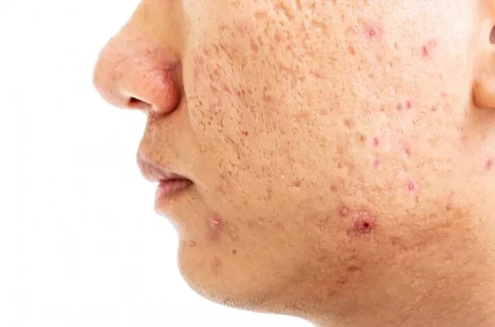 Dermabrasion For Acne Scars: Overview, Benefits and Risks