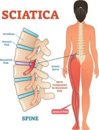 Sciatic Nerve Pain Relief: How Gabapentin 400 mg (Neurontin) Can Help