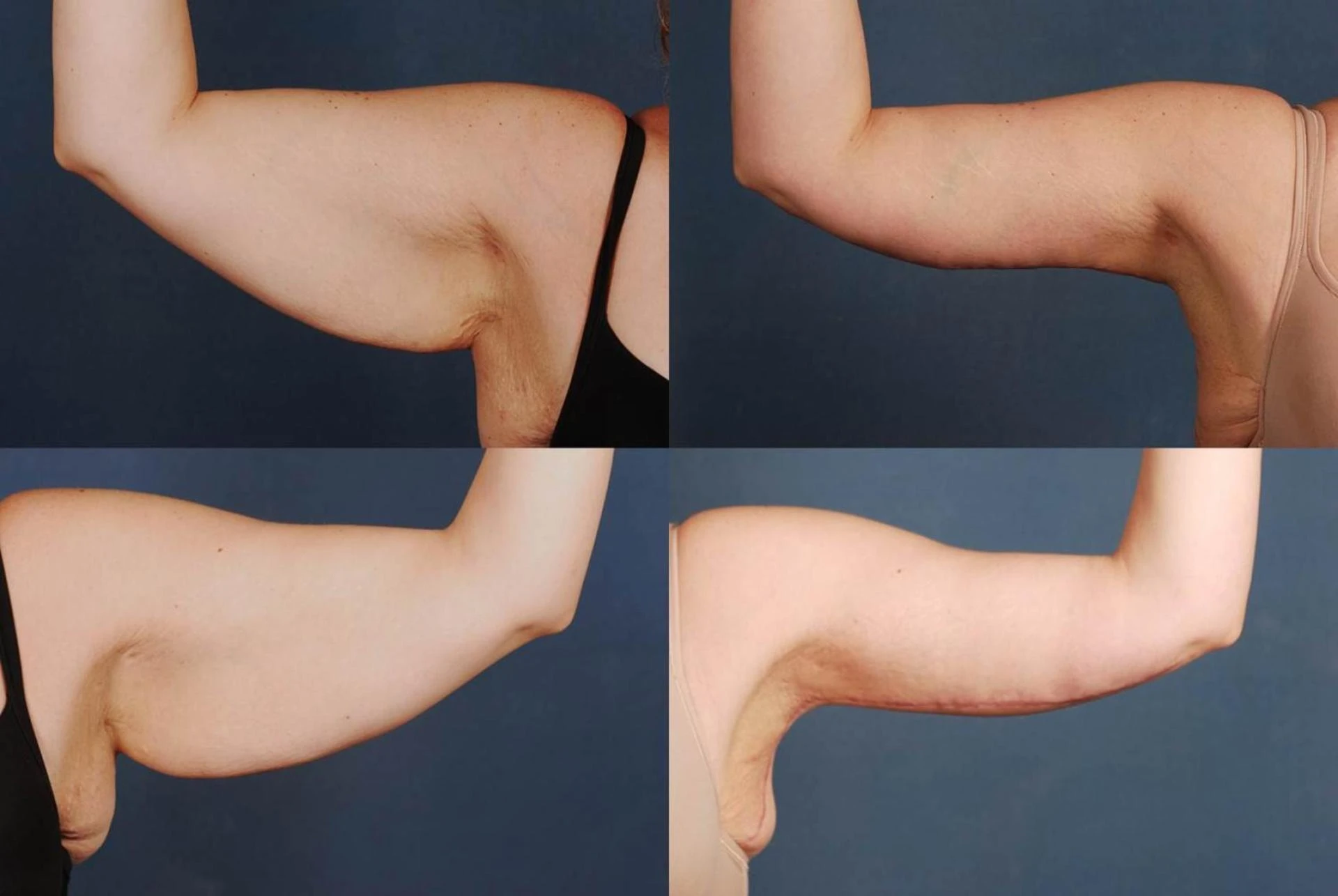 The latest arm lift techniques available in Riyadh clinics