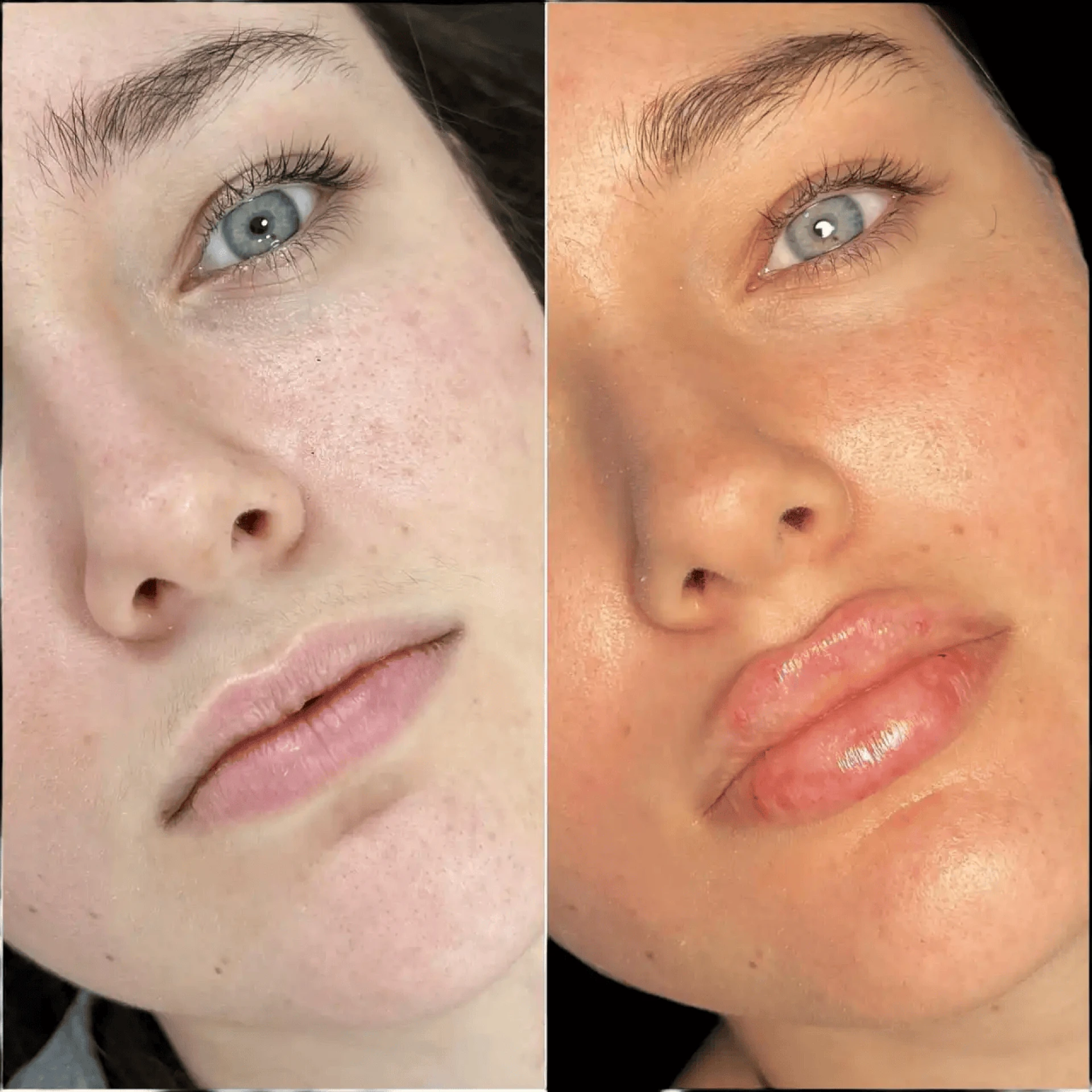 Best Plastic Surgeons in Dubai for Fillers: Confidence Starts Here
