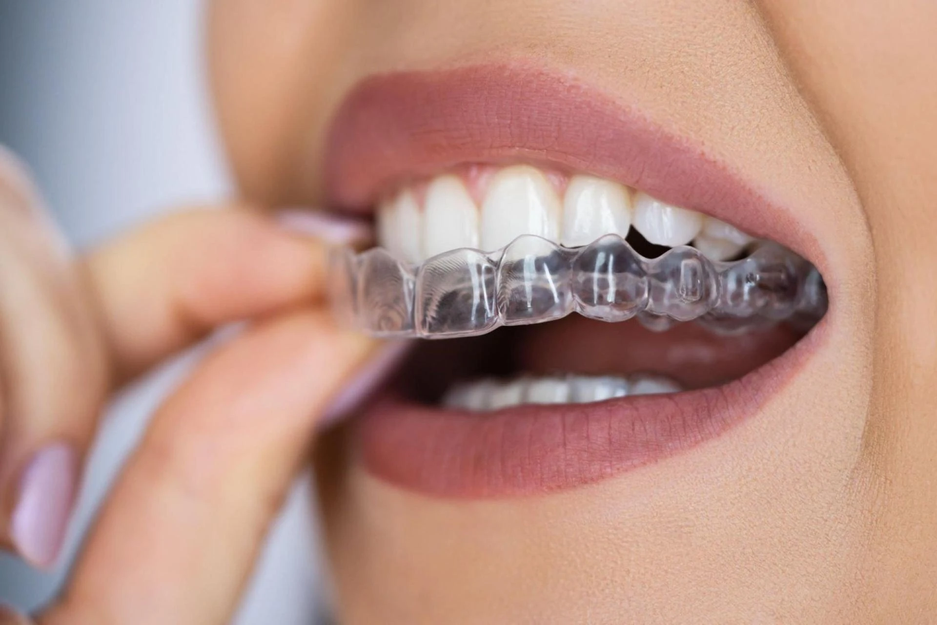 6 Interesting Myths About Invisalign Treatment