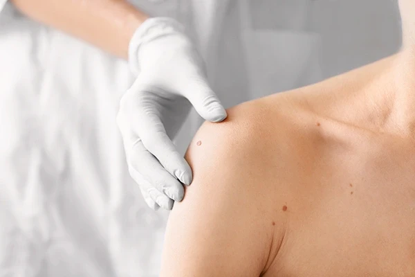 What Type of Mole Removal Treatment Is Best?