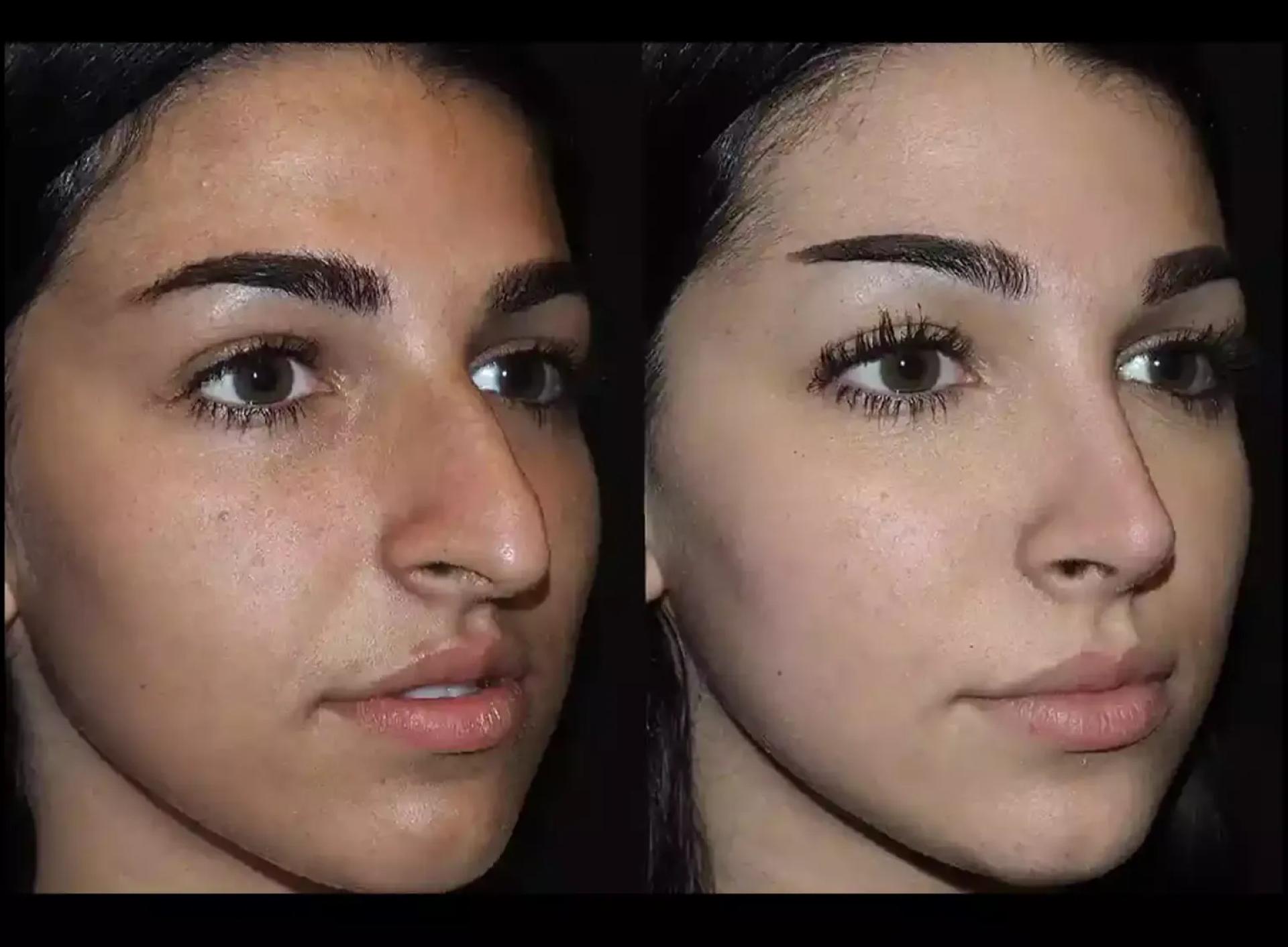 Teen Rhinoplasty in Dubai: Age and Safety Guidelines