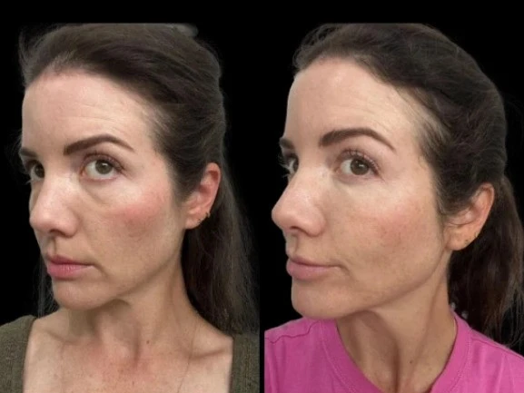 How the Best Aesthetic Clinics in Dubai Treat Dark Circles with Fillers and Lasers