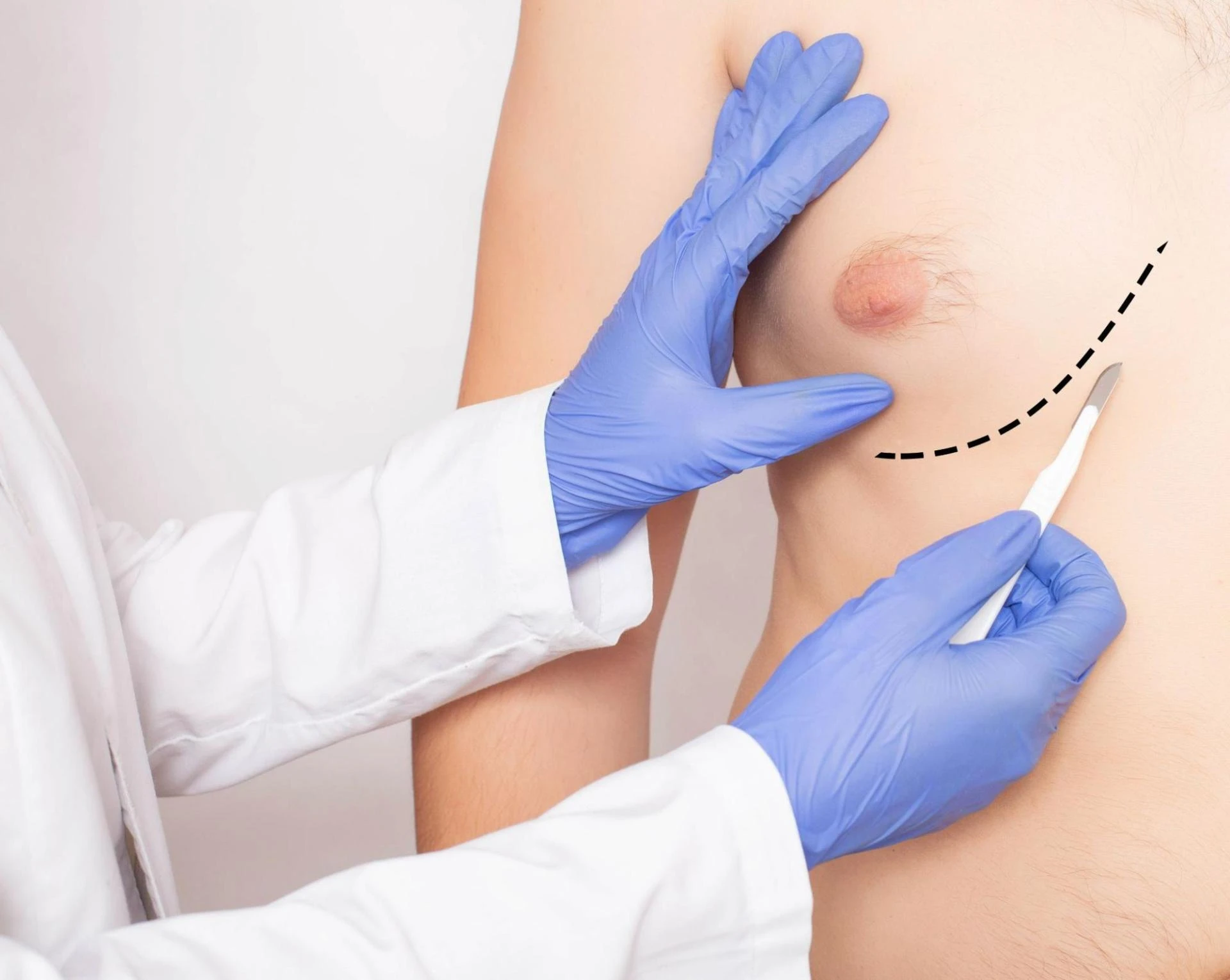Can Exercise Alone Cure Gynecomastia? Surgical vs. Non-Surgical Options