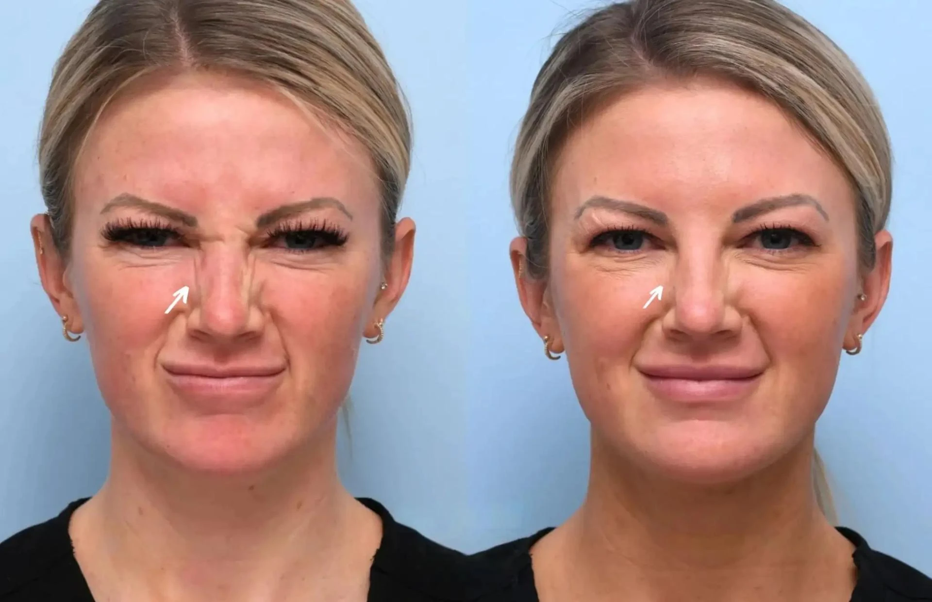 Botox for Neck Lines: What the Best Doctors in Dubai Recommend