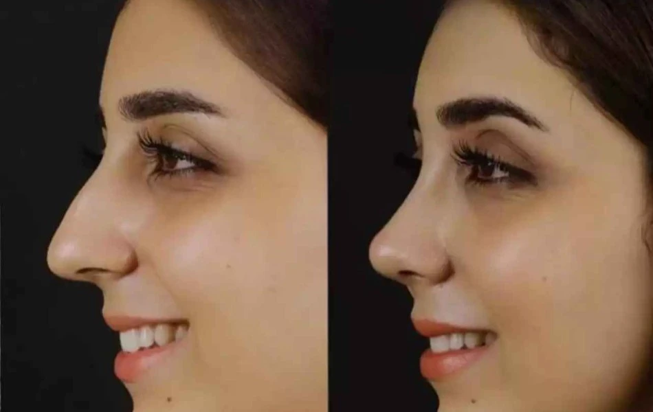 What Qualities Define the Best Septoplasty Surgeon in Dubai?