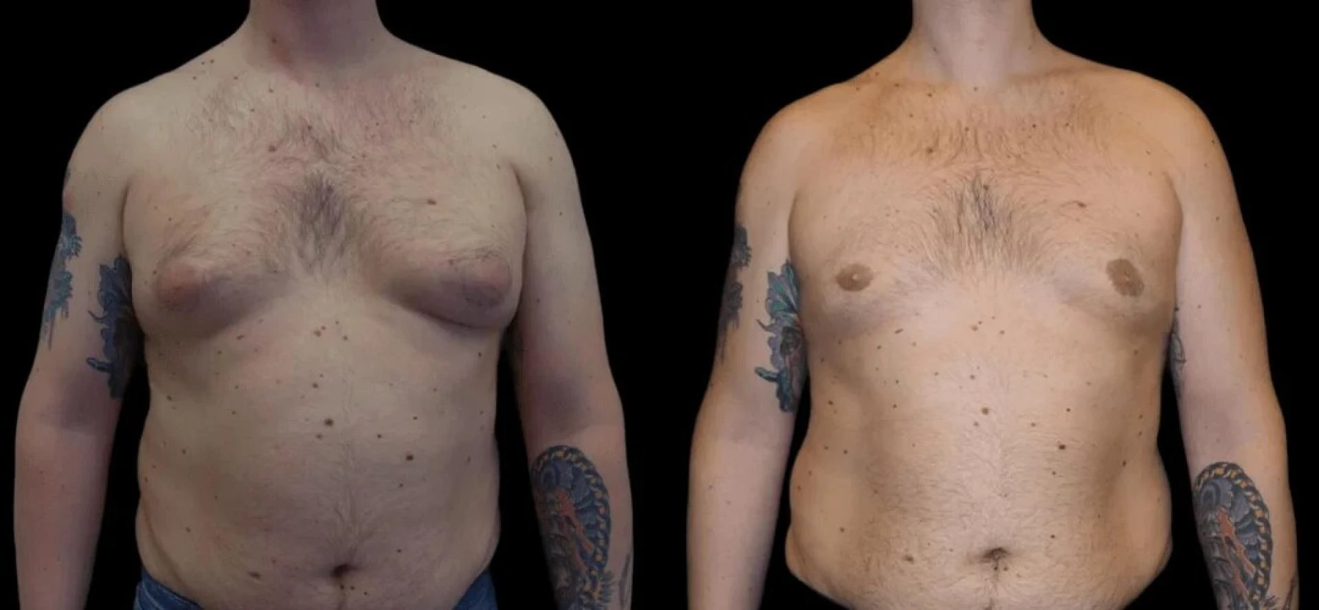 Gynecomastia Men in Dubai: Treatment Options That Work
