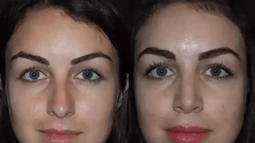 Natural Beauty Refined by the Best Doctors in Dubai for Rhinoplasty
