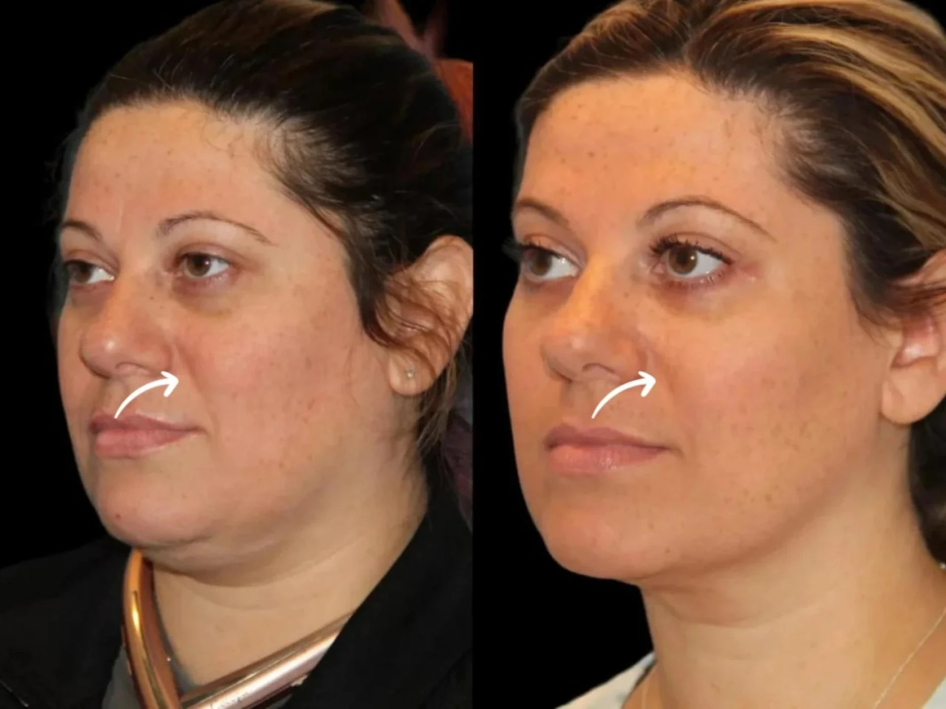 Best Aesthetic Clinics in Dubai: Sculptra Oral Care