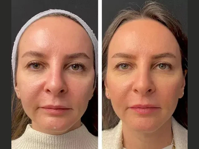 How to Choose the Best Plastic Surgeons in Dubai for Your Mesotherapy Treatment