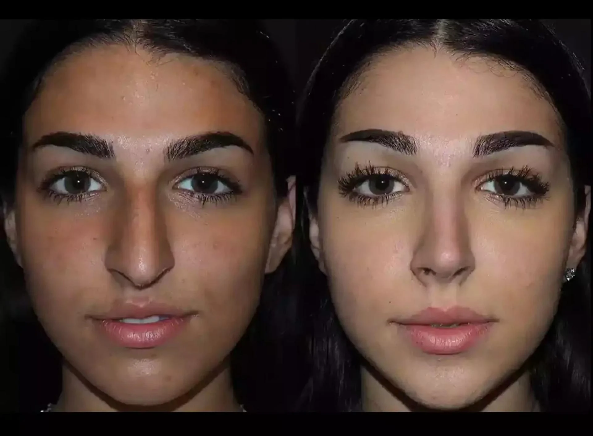 How Septoplasty in Dubai Improves Both Health and Lifestyle