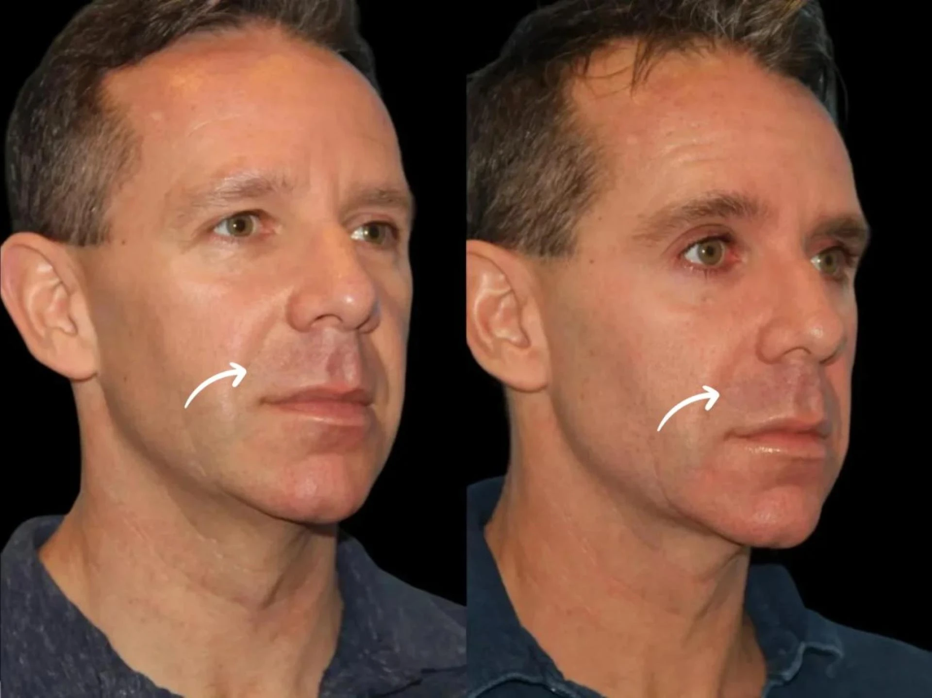 Best Doctors in Dubai for Sculptra with Digital Mapping