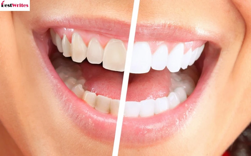 Dental Cleaning: Complete Guide to Healthy Teeth | Best Writes Links
