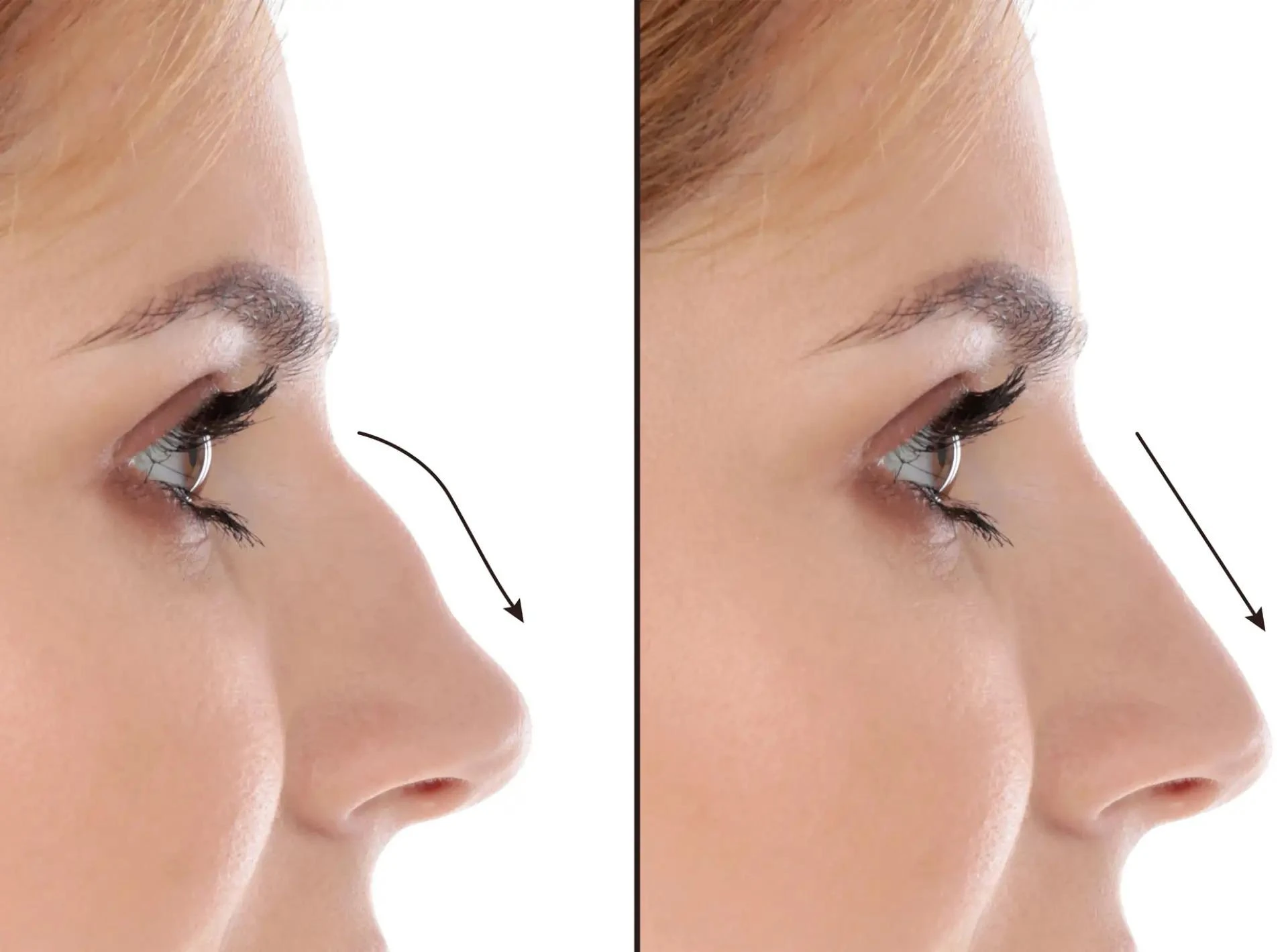Nose Deviated Septum Surgery in Dubai: Long-Term Results & Patient Outcomes