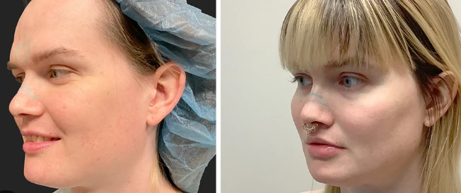 Comparing Facial Feminization and Traditional Aesthetic Surgery