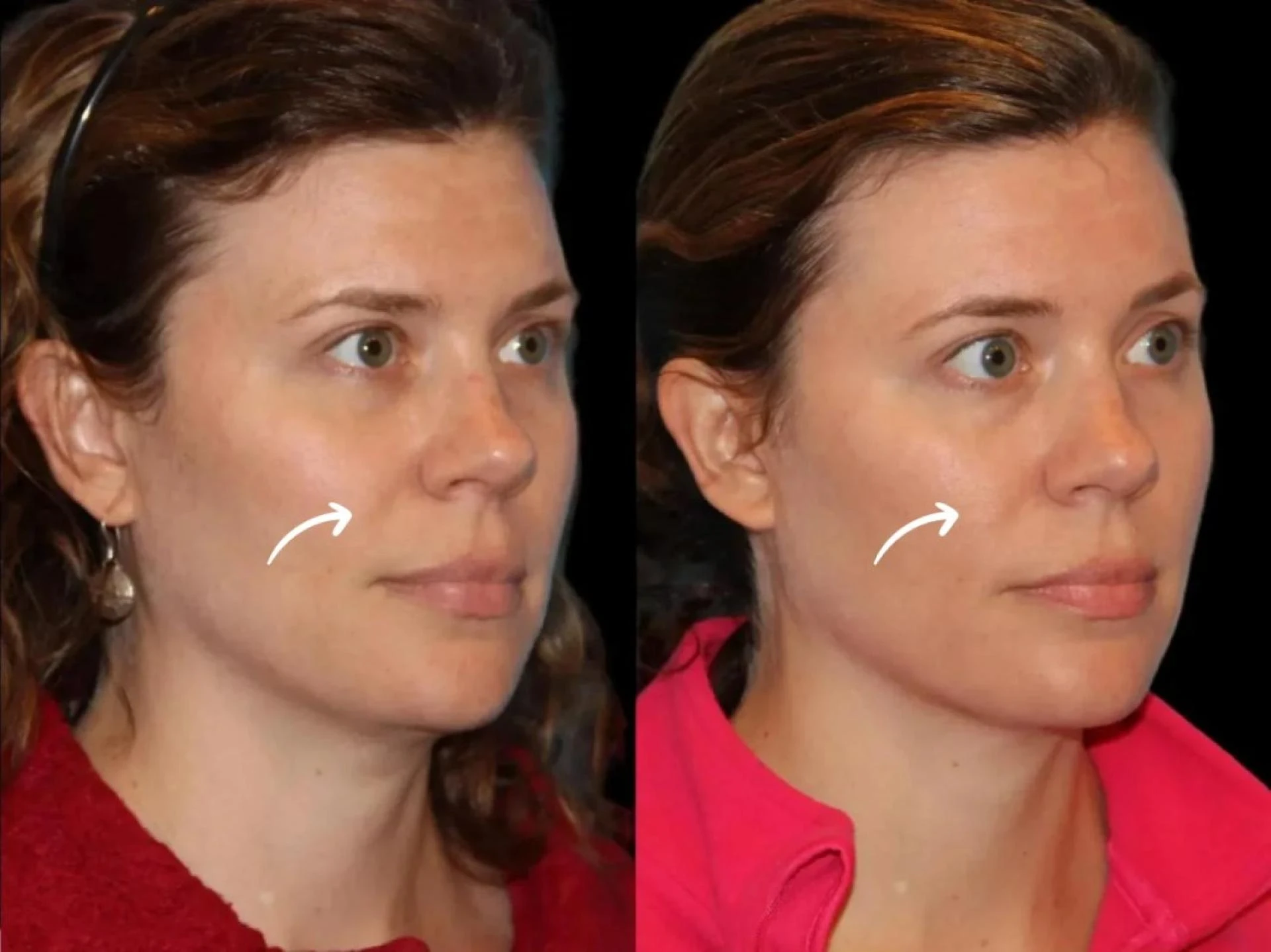 Improving Skin Thickness with Sculptra Treatment in Dubai Results Explained