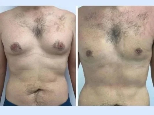 What Sets the Best Gynecomastia Surgeons in Dubai Apart in Treating Severe Gynecomastia Grades