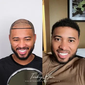 Hair Loss Affects 