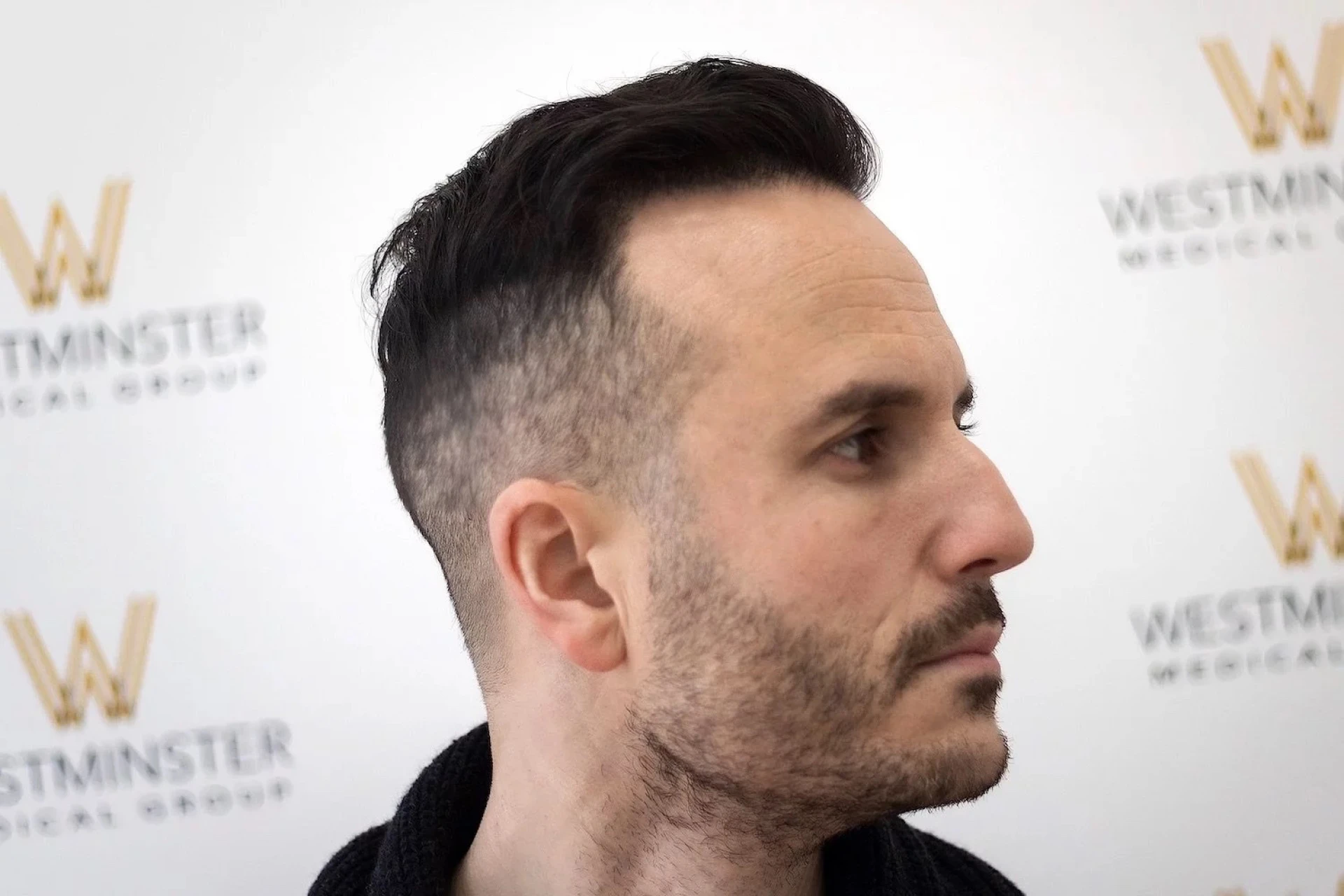 How To Spot a Bad Hair Transplant (and How Skilled Surgeons Fix Them)