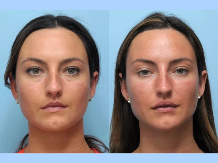 Natural-Looking Thread Lift Results at the Best Aesthetic Clinics in Dubai